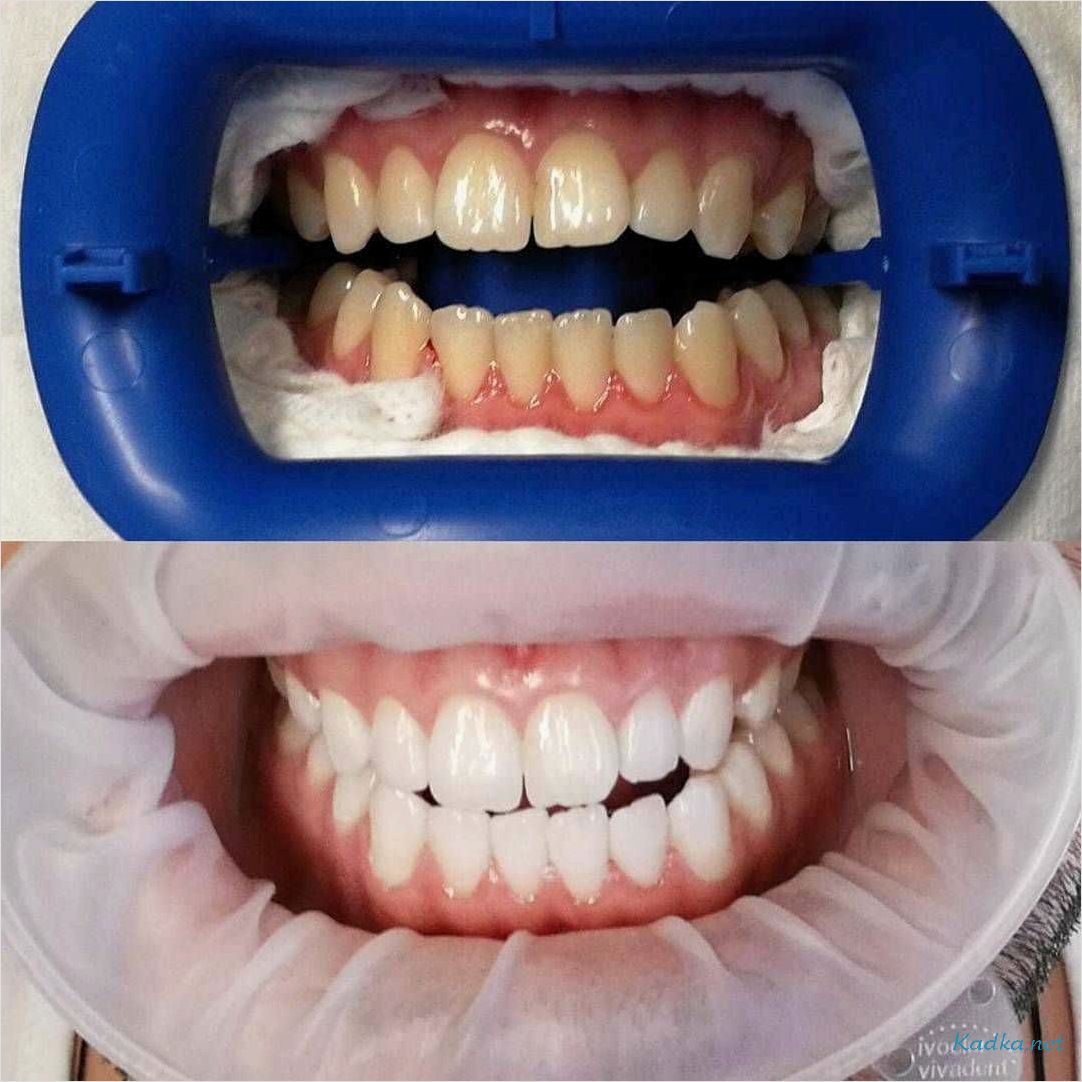 Отбеливание зубов год