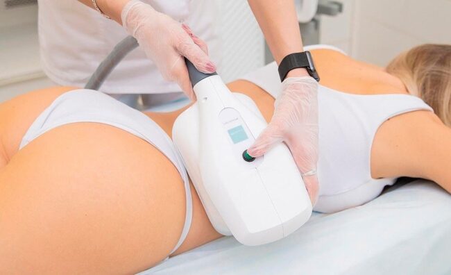 Kryolipolyse als effektiver Weg, um von übermäßigem Gewicht loszuwerden